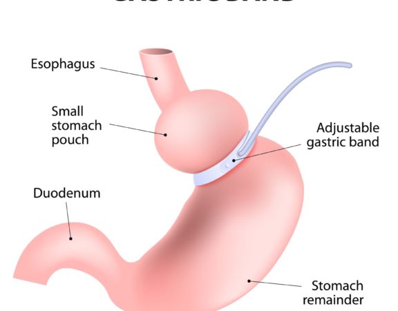 Phentramin-D Weight Loss Surgery Types for Obesity gastric band diagram